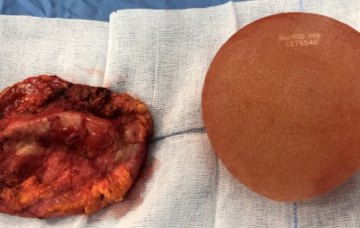 Linfoma anaplasico de celulas grandes relacionado con implantes mamarios